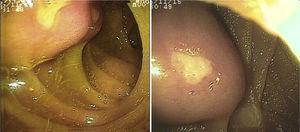 Ulcerated GIST in the jejunum.