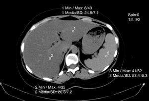 Non-contrasted computed tomography scan with Hounsfield unit measurement in the liver and spleen.