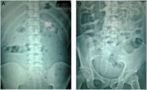 Radiographic progression of the patient, showing a normal radiographic pattern on the 5th day of treatment for C. difficile infection (A). However, on the 12th day of antimicrobial treatment, the patient presented with clinical worsening and important bowel segment dilation can be seen (B).