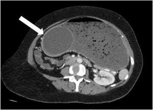 Oblique axial CT image showing the intragastric balloon embedded in the antrum of the stomach.
