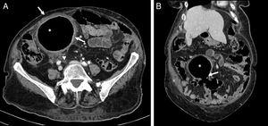 A) Axial view of the abdominal CT scan. A cystic lesion is seen in the RIF (*), with thickened walls (arrows) and inflammatory changes in the surrounding fat (arrowhead). B) Coronal reconstruction of the abdominal CT scan. The communication of that structure (*) with the sigmoid colon (arrow) is confirmed, corresponding to an inflamed giant diverticulum of the sigmoid colon.
