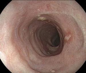 Endoscopic control at 90 days, with no stricture or residual lesion after corticoid therapy.