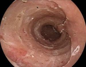 Esophagus after endoscopic dissection of the submucosa.