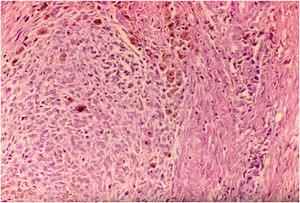 Medium magnification photomicrography (H&E) with macrophages with hemosiderin inclusion.