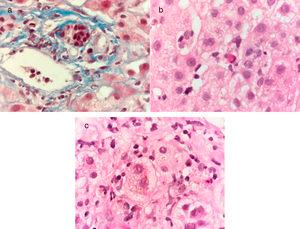 Masson stain at x100 shows a mononuclear inflammatory infiltrate in the portal area and interlobular bile duct damage characterized by nuclear polarity alteration, nuclear contour irregularity, and hyperchromasia a). Hematoxylin & eosin stain at x100 shows cholestatic chronic hepatitis with lobular activity due to the presence of scant mononuclear inflammatory cells and apoptotic hepatocytes b), as well as intracytoplasmic cholestasis and ballooning degeneration of the hepatocytes c).