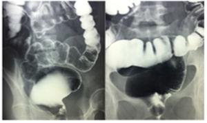 Barium enema showing megarectum.