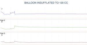 Conventional anorectal manometry trace showing the absence of the inhibitory rectoanal reflex with the maximum tolerable rectal capacity.