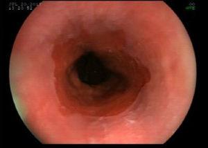Control upper GI endoscopy showing esophageal mucosa with no lesions.