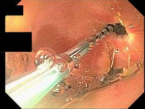 Endoscopic image of the pylorus during EndoFLIP®, showing catheter through the pylorus with 40 cc balloon distension.