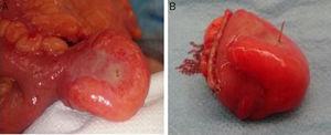 A) Aspect of the Meckel's diverticulum with inflammatory signs and the presence of a foreign body at its tip. B) Detailed image of the surgical specimen with a fish bone completely penetrating the diverticular wall.