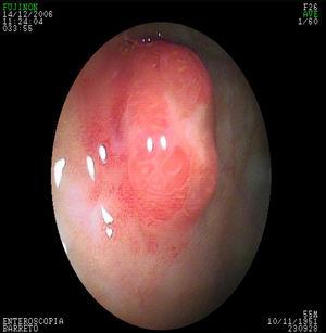 Ulcerated gastric neuroendocrine tumor.