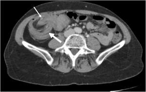 Axial view of the abdominal CAT scan: invagination of the ileum (thin arrow) in the transverse colon (thick arrow). «Target sign» image.