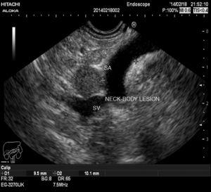 Endoscopic ultrasound (EUS) image of a non-functioning pancreatic neuroendocrine tumor (NF-PNET).