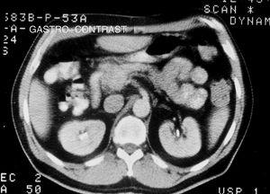 Computed axial tomography (CAT) scan of a pancreatic carcinoid tumor in the uncinate process.