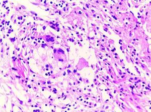 Optical microscopy image (hematoxylin & eosin, x20) showing a chronic inflammatory infiltrate with eosinophilic predominance, edema, and fibroblastic reaction.