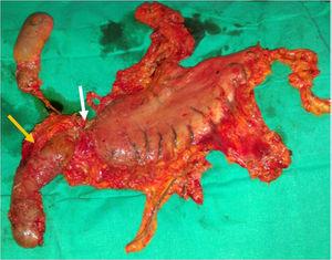 Surgical specimen. White arrow: antropyloric stricturing lesion affecting the first and second portions of the duodenum. Yellow arrow: duodenum-pancreas.