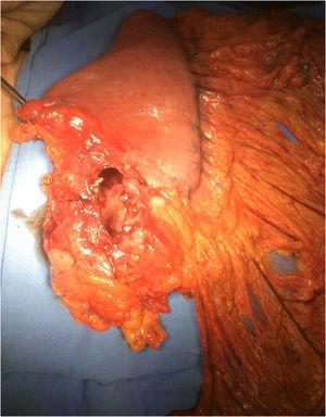 Surgical specimen showing the perforation in the gastric antrum.