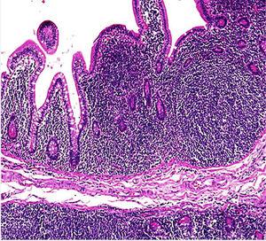 Photomicrography of mantle cell lymphoma affecting the intestinal mucosa. A nodular proliferation of small, cleaved lymphocytes that cause a polypoid configuration of the mucosa can be seen (hematoxylin and eosin, ×40).