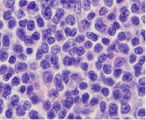 Cytology image shows small cells with hyperchromatic and cleaved nuclei, with scant cytoplasm (hematoxylin and eosin, ×400).