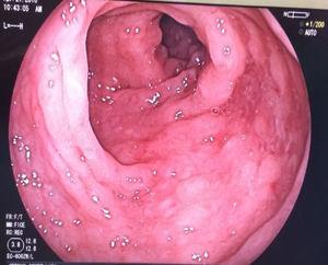 Colonoscopy: polypoid lesions located in the sigmoid colon.