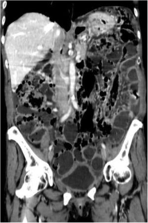 Abdominal tomography scan with coronal reconstruction showing diffuse pneumatosis intestinalis with a predominantly cystic pattern.