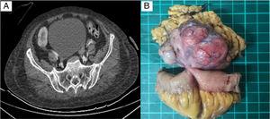 A) Contrast-enhanced lesion with hypodense areas in its interior. B) Multilobulated tumor dependent on the intestinal wall.