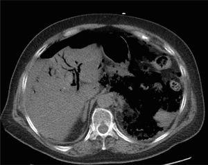 Axial view at the hepatic level, showing pneumobilia and the presence of a large quantity of intra-abdominal gas.
