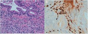 A and B: Biopsies of the proximal bile duct with superficial erosions and interstitial chronic inflammatory infiltrates.