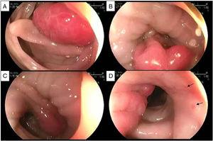 Sequential images of the endoscopic appearance of a prolapsing mucosal polyp. A) Lobulated, bright, hyperemic mass. B) Obliteration of the lumen and long-standing spasm are present, showing a prolapsing mucosal polyp with a broad stalk. C) Retraction of the prolapsing mucosal polyp that continues with redundant mucosal folds. Notice the transition from congestive hyperemic mucosa to normal-looking surrounding mucosa. D) Lateral aspect of the lesion showing the redundant mucosal folds with petechiae (arrows).