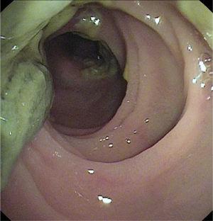 Meconium in the small bowel in a post-lung transplantation patient. Unblocking performed through double-balloon enteroscopy.
