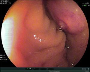 Subepithelial tumor lesion in the duodenum (GIST).