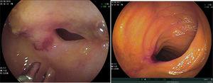Ulcer and stricture due to Crohn's disease and inflammatory ulcers caused by NSAID use.