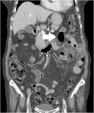 At physical examination there was pain upon palpation, with guarding and positive decompression. Laboratory test results revealed leukocytosis and neutrophilia. The abdominal computed tomography scan revealed jejunal diverticula, inflammatory changes in the mesentery, and pneumoperitoneum.