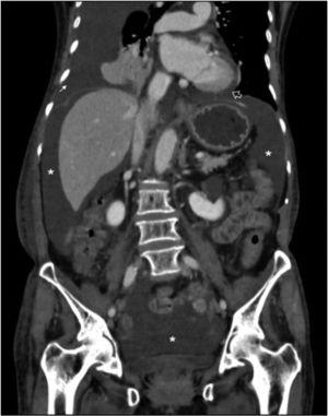 Coronal view of the abdominal and pelvic tomography scan showing pleural effusion (arrow), pericardial effusion (hollow arrow), ascites (asterisks [*]), and soft tissue edema.