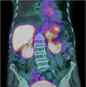 Coronal view of the SPECT/CT with 99mTc-labeled human albumin scintigraphy showing diffuse concentration of the radiotracer in the lumen of the jejunum and ileum (hollow arrows), with intestinal loss of albumin consistent with protein-losing enteropathy.