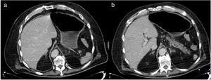 a) CAT scan showing no evidence of abnormal thickening of the stomach, and resolution of the pneumatosis can be seen; b) Decrease in portal vein gas, with the presence of a thrombus in the left branch.