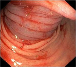 Colonoscopy performed after rectal prolapse reduction, identifying colonic intussusception. It was not possible to distinguish the lumen.