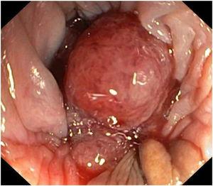 Introduction of the colonoscope adjacent to the vegetative lesion, where the lumen was identified in the exteriorized prolapse.