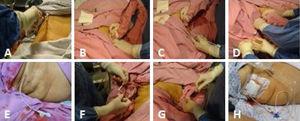 (A) Asepsia del hipocondrio derecho. (B) Exploración de la vesícula biliar. (C) Introducción guiada por ecografía del catéter junto con la guía metálica en dirección a la vesícula. (D) Se extrae la guía metálica cuidando de dejar el catéter en su sitio, orientado hacia la luz de la vesícula, y corroborando de nuevo mediante ecografía su adecuada posición dentro de la vesícula. (E) El catéter de colecistostomía colocado. (F) El catéter se fija con una simple sutura a la piel utilizando prolene 3-0. (G) Se aspira el líquido biliar y se envía para su cultivo. (H) El catéter de colecistostomía de derivación con la bolsa de recogida.