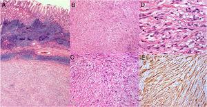 A section of the surgical specimen (×40) (A). A well-circumscribed submucosal mesenchymal tumor arising from the sheath of Auerbach’s plexus, consisting of spindle cells arranged in cross bundles accompanied by hyalinized fibrillar material (B, C, D). Immunohistochemistry displaying S-100 and glial fibrillary acidic protein positivity (E).