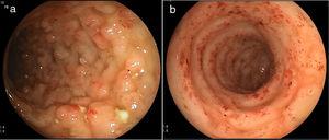 a) Edematous colonic mucosa, with a nodular pattern, erythema, and ulcers. b) Sigmoid colon with flattened haustra, vascular pattern loss, edema, erythema, and erosions.