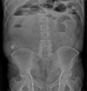 Abdominal x-ray showing intestinal segment dilation and air-fluid levels. The patency capsule can also be seen.