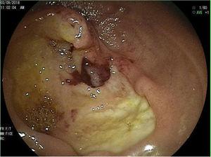 An almost completely ulcerated stricture in the third part of the duodenum.