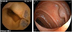 Hemangiomas: A) Observed through capsule endoscopy B) Observed through enteroscopy.