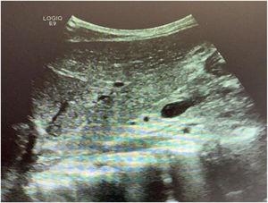 Control ultrasound image before hospital release.