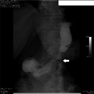 Contrast swallow in patient with gastric stricture. Image showing sleeve stricture (white arrow) and dilatation of the upper stomach and esophagus (black arrow).