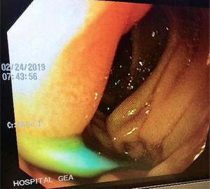 Upper gastrointestinal endoscopy image corroborating the migration site and perforation by the plastic stent.