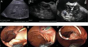 A) Hepatobiliary ultrasound identifying a liver abscess larger than 10 cm. B) Linear view of the liver abscess, through endoscopic ultrasound. C) Transgastric puncture of the abscess, D) passage of the covered metallic stent, in which drainage of abundant thick purulent material can be seen. E) Dilation of the proximal end of the stent, F) passage of the coaxial double-pigtail catheter into the metallic stent.