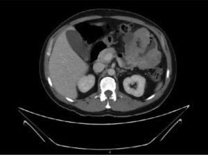 Axial view of the abdominal CT scan showing the mamelonated mass that encompasses several intestinal segments in the left hypochondrium.