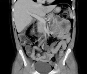Coronal view of the abdominal CT scan showing the mamelonated mass in the left hypochondrium.